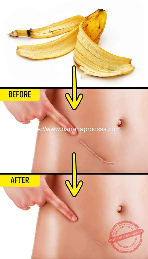 Banana-Peel-Reduce-Scars